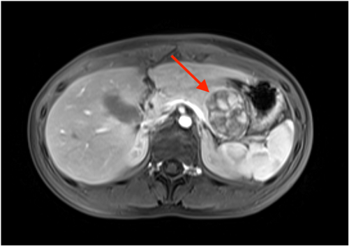 JPGNReports's tweet photo. Litwin et al 🔍 When a “pseudocyst” isn’t..

11yo with #pancreatitis → cyst → yrs later = Solid pseudopapillary epithelial neoplasm 😳

🔑 atypical course + solid components on MRI

Pancreatic tumors can masquerade!

#PedsGI #Pancreas #PancreasTwitter #MedTwitter 

🔗 https://t.co/vtHdc9ncAt
