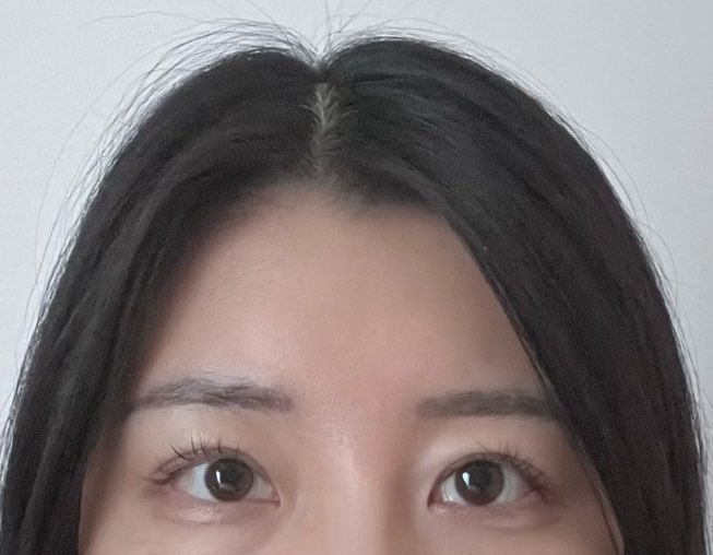 kitty_tiny_'s tweet photo. ザビビ美容外科で額挙上手術、目の上脂肪除去をして2ヶ月が経ちました！
ダウンタイムが落ち着いてきて自然になりました🎶頭皮の感覚麻痺は若干ありますがほとんど改善されています！頭痛なども特になく過ごせています！
@TheBBjp https://t.co/O1qOMZTCCb
