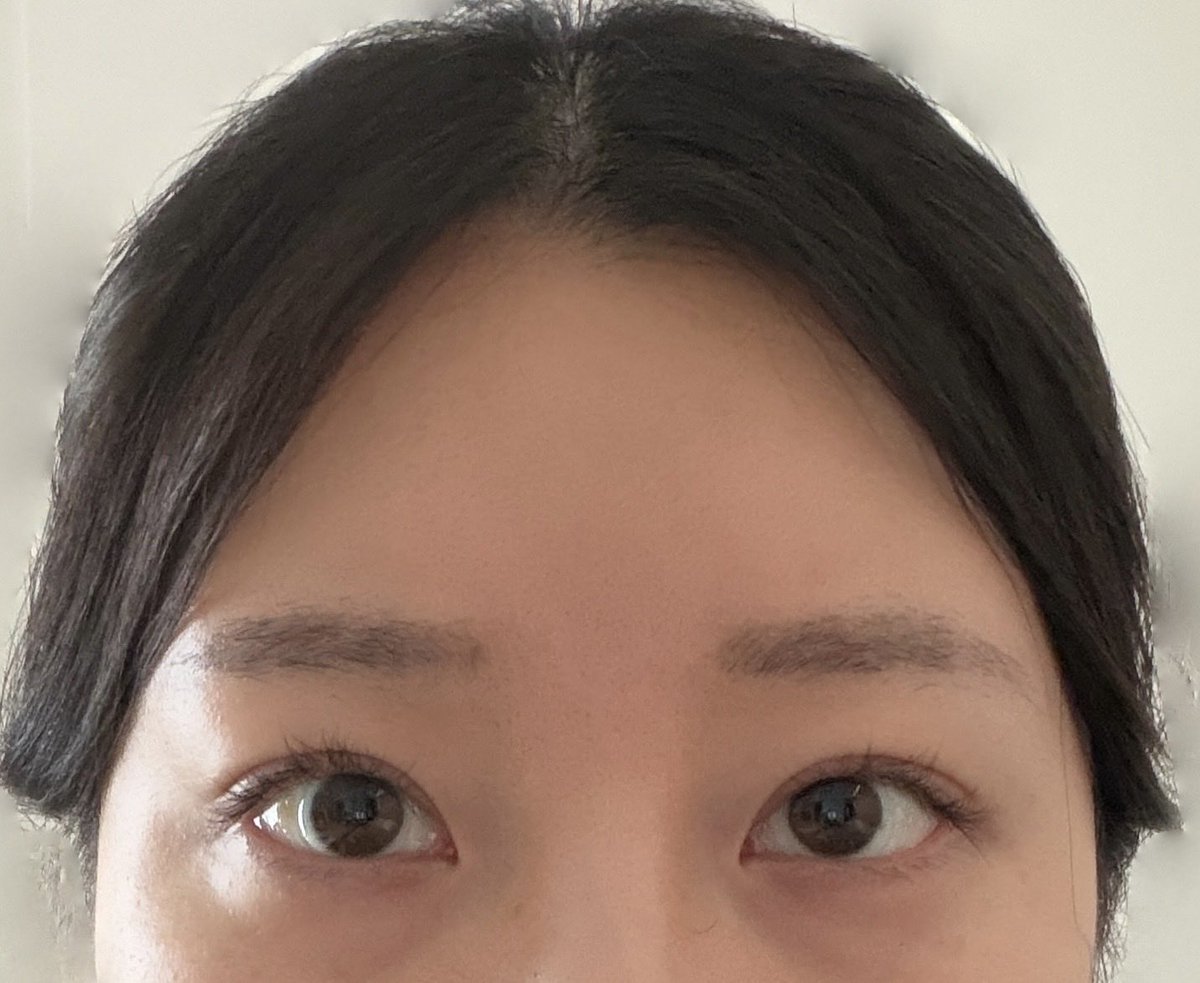 kitty_tiny_'s tweet photo. ザビビ美容外科で額挙上手術、目の上脂肪除去をして2ヶ月が経ちました！
ダウンタイムが落ち着いてきて自然になりました🎶頭皮の感覚麻痺は若干ありますがほとんど改善されています！頭痛なども特になく過ごせています！
@TheBBjp https://t.co/O1qOMZTCCb