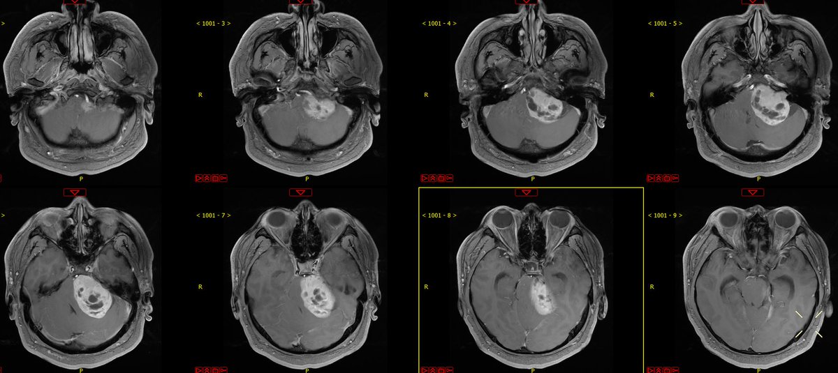 XiefengWang's tweet photo. Gross total resection of a gaint acoustic neuroma last week with anatomical preservation of the facial nerve and a postoperative HB grade III outcome. My Mayo Clinic experience continues to remind me that patience and meticulous attention matter in every surgery.@GLanzinoNSGY https://t.co/Zjfmv5YfSM
