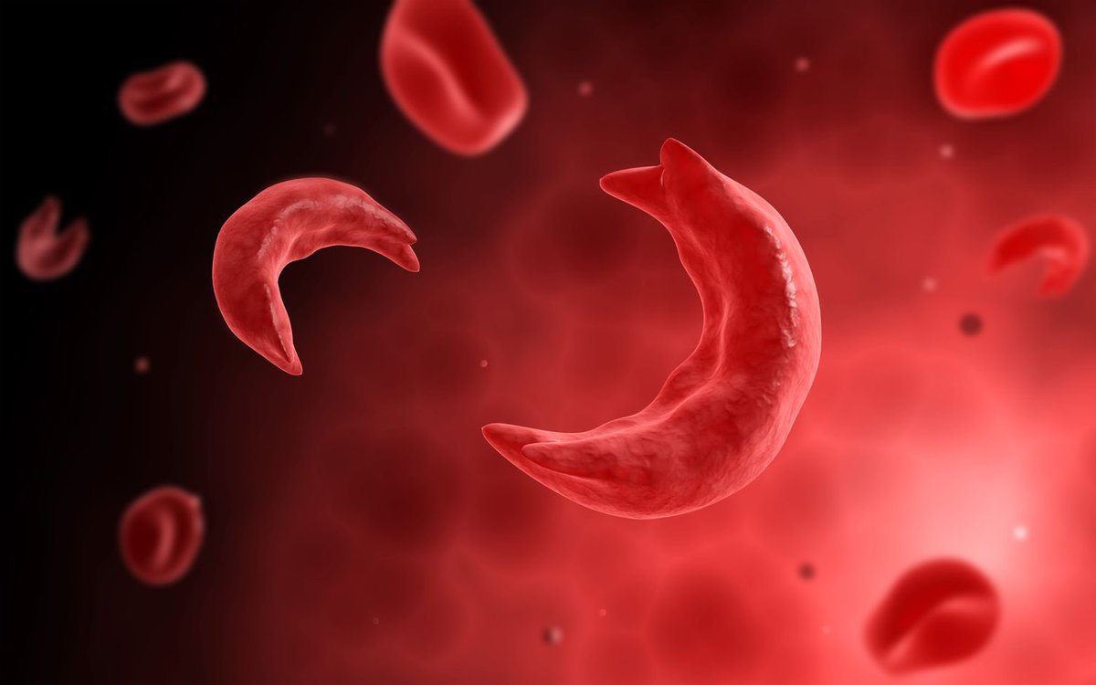 Celine682117's tweet photo. As the world marks World Sickle Cell Day, Nigerian-born sickle cell warrior Kesiena Ikeke has issued a passionate call to end stigma, rejection, and systemic neglect facing patients across West Africa.she noted that poor medical care and forced left her with physical scars. https://t.co/3IC9LIatuo