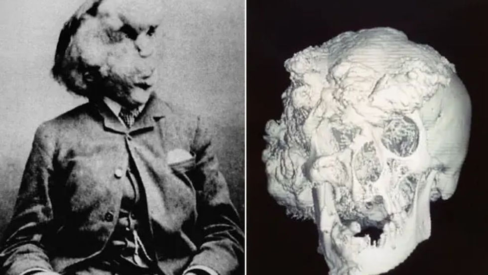traumatogeek's tweet photo. El caso médico que horrorizó a Londres... y la ciencia tardó cien años en resolver.

Es 1884. Los sótanos de la ciudad huelen a ginebra y morbo. La gente hace cola y paga en chelines para ver a la mayor aberración de la naturaleza: "El Hombre Elefante".

El mito vende, dicen que su madre fue aplastada por un paquidermo estando embarazada.

Llaman al cirujano Frederick Treves para que examine a la bestia. Cuando cruza la puerta, se queda mudo. Jamás había visto nada igual.
Un brazo derecho gigante. El cráneo sepultado bajo masas de hueso. Las piernas arqueadas. Una pesadilla traumatológica.

La sociedad ya ha dictado sentencia. Es un monstruo. Pero Treves no huye. Se acerca y le habla.

Aunque lo que descubre le rompe los esquemas. Debajo de esa armadura de hueso deforme no hay ninguna bestia. Hay un chaval llamado Joseph Merrick. Aterrorizado pero brillante y con una educación exquisita.

Treves lo saca de ese circo asqueroso y le da asilo en su hospital. Lo cuidó hasta el final, pero el gran cirujano se fue a la tumba con una frustración: no tenía ni idea de qué enfermedad estaba machacando el cuerpo de su amigo.

Tuvimos que esperar casi cien años. Hasta la tecnología de ADN para resolver el misterio del esqueleto de Merrick.

Tenía el Síndrome de Proteus. Una mutación rarísima que apaga los frenos del cuerpo y hace que los huesos y tejidos crezcan a lo bestia, sin límite.

Merrick no era un monstruo. Era alguien con una enfermedad ortopédica gravísima, que tuvo la desgracia de nacer en la cumbre de la ignorancia.

La verdadera monstruosidad de esta historia nunca fue su esqueleto. Fue una sociedad que pagaba por reírse de él.

#LaTraumatologaGeek
