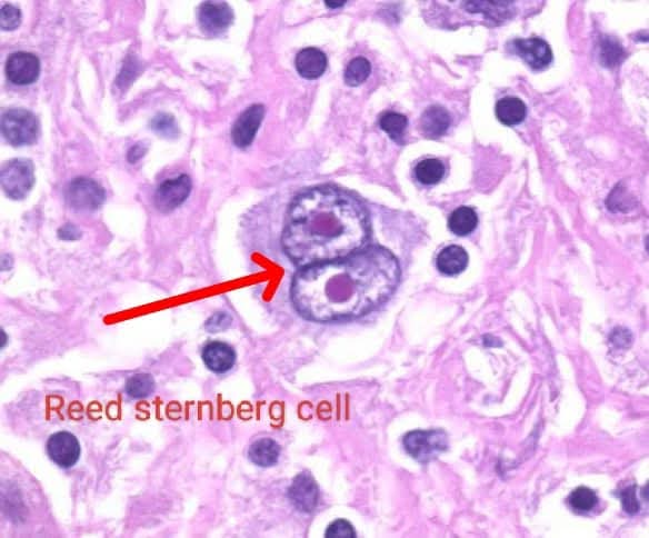Chiragrx07's tweet photo. Which Condition shows this histology finding ?? https://t.co/tEeMAWEEyM