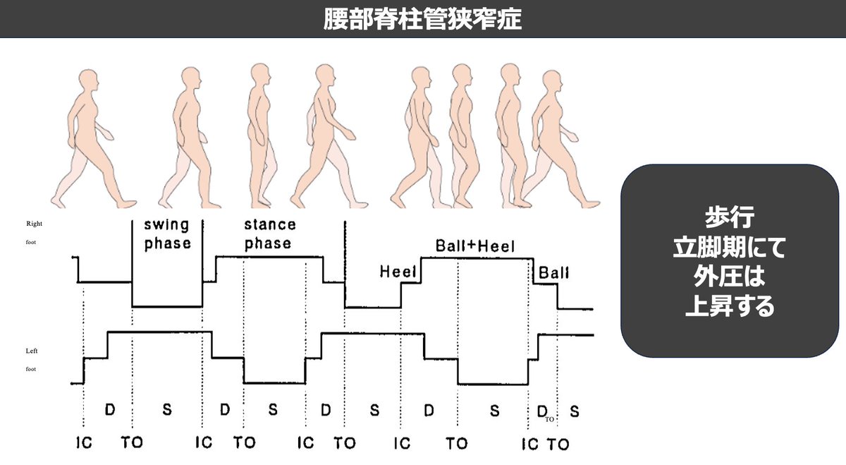 mori_pt_gbc's tweet photo. 腰部脊柱管狭窄症にまつわる情報です。   
病態、歩行、椎間孔、バビ神経の動態についてまとめています。
参考になれば幸いです。 

セミナー参加はこちらから
https://t.co/Nql0U2Xk2E https://t.co/qs0kmfEdqV