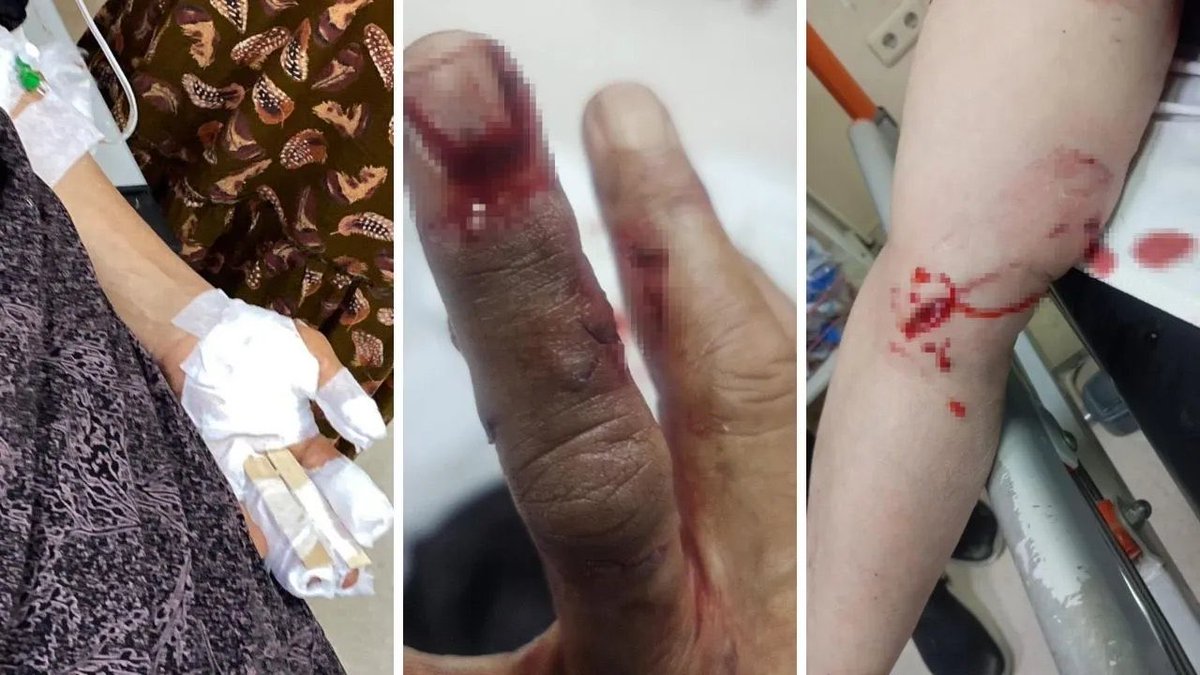 aslihan_ercan's tweet photo. Şırnak Silopi…

Bir tarafta gururla köpek bakım çiftlikleri açılırken diğer tarafta gariban vatandaşı köpekler avlamaya devam ediyor…

📌Yaşları 50’nin üzerinde 3 teyzemize başıboş köpekler yaralamış…

Başıboş %83’ü toplanmış bir ülkede her gün köpek saldırısı olmaz…

Toplandığı halde halen oluyorsa, toplamayla çözülmeyeceğini de idrak şarttır…

Hem milyarlar ile başıboş köpek bakılacak, hem gariban vatandaş yine yeniden köpeklerce avlanacak…

Kağıt üzerinde aya tesis açmakta mümkün!!!

Gerçekler öyle değil…