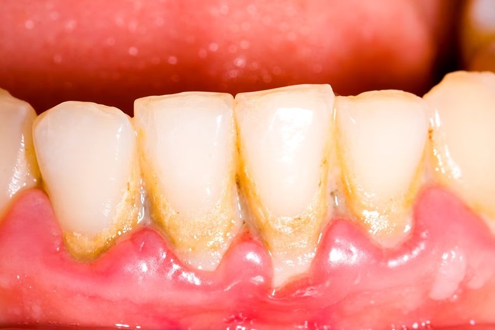 Outdoctrination's tweet photo. Brushing with baking soda removes dental plaques, often by ~85%, according to a meta analysis.

A more recent study showed that baking soda outperformed conventional fluoride toothpaste for plaques and gingivitis.

Potentially by:

1. Physical displacement of plaques
2. Reducing viscosity of plaque matrix
3. Improving plaque penetration by the brush
4. Antimicrobial effects

This paper was published last year, comparing:

➥ A baking soda toothpaste with some (0.31%) fluoride

to

➥ A high fluoride (0.73%) toothpaste

People in the study had confirmed plaque + gingivitis.

1 minute of brushing, twice daily.

Within 3 weeks, baking soda reduced the number of bleeding sites by 2.4.

The high fluoride toothpaste increased the number of bleeding lesions.

In 3 months, baking soda reduced them by over 4.

fluoride increased them by >2.

The bleeding index only decreased with baking soda.

Baking soda also reduced gum inflammation.

Both products had an effect, but at every time point, baking soda was superior.

Baking soda reduced dental plaques, too.

Once again it outperformed the conventional high fluoride toothpaste.

It's important to note that not only does baking soda outperform fluoride in these studies, it's much safer, considering fluoride is a toxin.

Studies:

PMID: 19278079
PMID: 40482904
