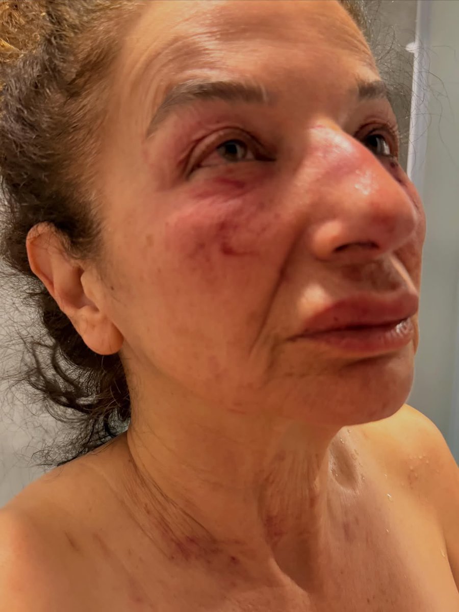 zeyyerinde1's tweet photo. Tüm yaşam hakkı savunucularına ve sevgili yoldaşlara,

Dün İzmir Selçuk’ta yıllardır sokaktaki canlar için mücadele veren, besleme yapan gönüllü arkadaşımız Beray Yürek çok ağır bir saldırıya uğradı.

Birkaç gün önce bir kişi kendisine ulaşıp Şirince yeni yol üzerinde sakat yavru köpekler olduğunu söylüyor. Günler boyunca mesaj atıyor, fotoğraflar gönderiyor ve ne zaman geleceğini soruyor. Dün saat 17.00 civarında Beray abla yavruları görmek için bölgeye gidiyor.

Şirince yeni yol üzerindeki noktadan zeytinlik alana doğru geçtiklerinde şahıs bir anda saldırıyor. Dakikalarca boğazını sıkarak öldürmeye çalışıyor, kemerle boğuyor, sürüklüyor ve telefonunu parçalıyor. Defalarca nefessiz kalmasına rağmen hayata tutunmayı başarıyor. Şahıs onu öldü zannederek olay yerinden uzaklaşıyor. Beray abla ise son gücüyle yola çıkıp yardım almayı başarıyor.

Bugün Beray ablanın hayatta olması mucizedir.

Kendisiyle görüştük. Yaşadıkları ortada. Bu olay sadece Beray’a yapılmış bir saldırı değildir. Sokaktaki canları koruyan, besleyen, yaşam hakkını savunan herkese verilmek istenen bir gözdağıdır.

Bizler yıllardır sokaktaki canları tehlikelerden korumaya çalışıyoruz. Ama artık görüyoruz ki onları koruduğumuz için bizler de tehlikedeyiz. Bugün Beray’a yapılan yarın başka bir gönüllüye, başka bir yaşam hakkı savunucusuna yapılabilir. Hiçbirimiz güvende değiliz.

Bu nedenle bu saldırının sıradan bir olay gibi görülmesine izin veremeyiz. Şahıs yakalandı ancak bununla bitmez. Bir insanı planlı şekilde ıssız bir alana götürüp öldürmeye çalışmanın bedeli olmalıdır. Bu şahıs elini kolunu sallayarak aramıza dönememeli, hak ettiği en ağır cezayı almalıdır.

Beray abla yalnız değildir. Bu olayın sonuna kadar takipçisi olacağız. Yaşam hakkını savunan insanları yalnız bırakmayacağız.

İletişim İnstagram:Berayyyk
@selcukkymklk @izmirvaliligi @drsuleymanelban 
#SonDakika #6284Yaşatır
#SokakHayvanlarıSahipsizDeğil