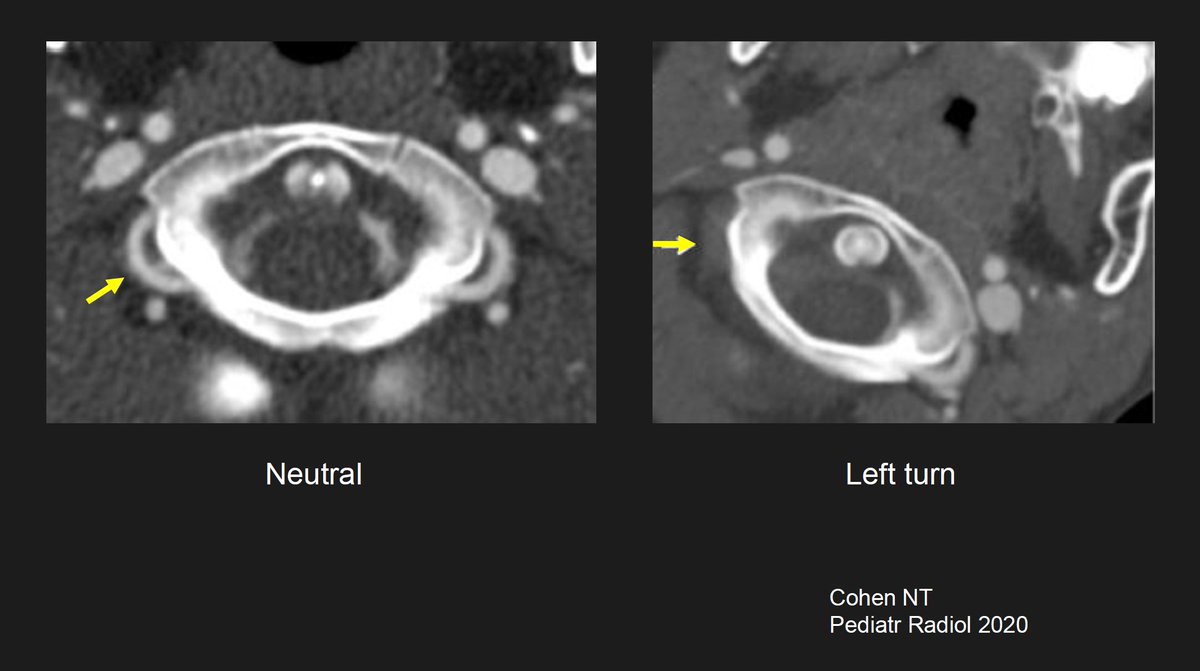 The_ASPNR's tweet photo. Live Now! 🧠Stepping further into the case vault, Decoding cerebral arteriopathies with Dr. Gilbert Vezina✨ Pearls: 🎙️ Recurrent posterior circulation strokes: Remember Bowhunter (positional vertebral artery occlusion) 🏹 and DADA (early-onset recurrent lacunar strokes)✨ #PediNeuroRad #IPNTN #PedsRad #ASPNR
@MirskyDavid @drmankad @RLClarkeMD @laura1127md @ArzuOztrkMD @alexandra_foust @DrSmilySharma @HarumyYoshikawa @JamieClarkeRad @MoriyahNaama @the_nvir