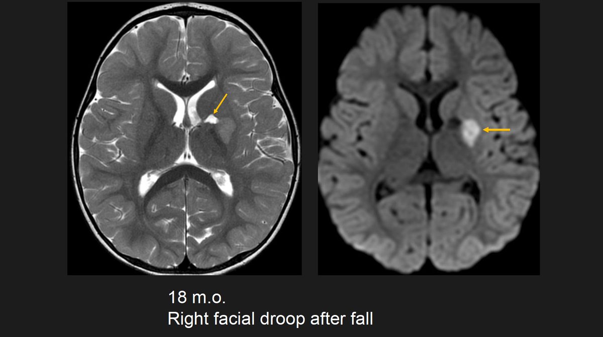 The_ASPNR's tweet photo. Live now!🧠 Dr. Gilbert Vezina concludes with high-yield  nuances✨ "The Little things matter"📖 1. Trivial trauma & basal ganglia stroke in <2 year old: Watch out for lenticulostriate mineralizing angiopathy ✨2. Don't expect coincidence: Even dermoid rupture can cause an infarct! #PediNeuroRad #PedsRad #IPNTN #ASPNR 
@MirskyDavid @drmankad @RLClarkeMD @laura1127md @ArzuOztrkMD @alexandra_foust @DrSmilySharma @HarumyYoshikawa @JamieClarkeRad @the_nvir