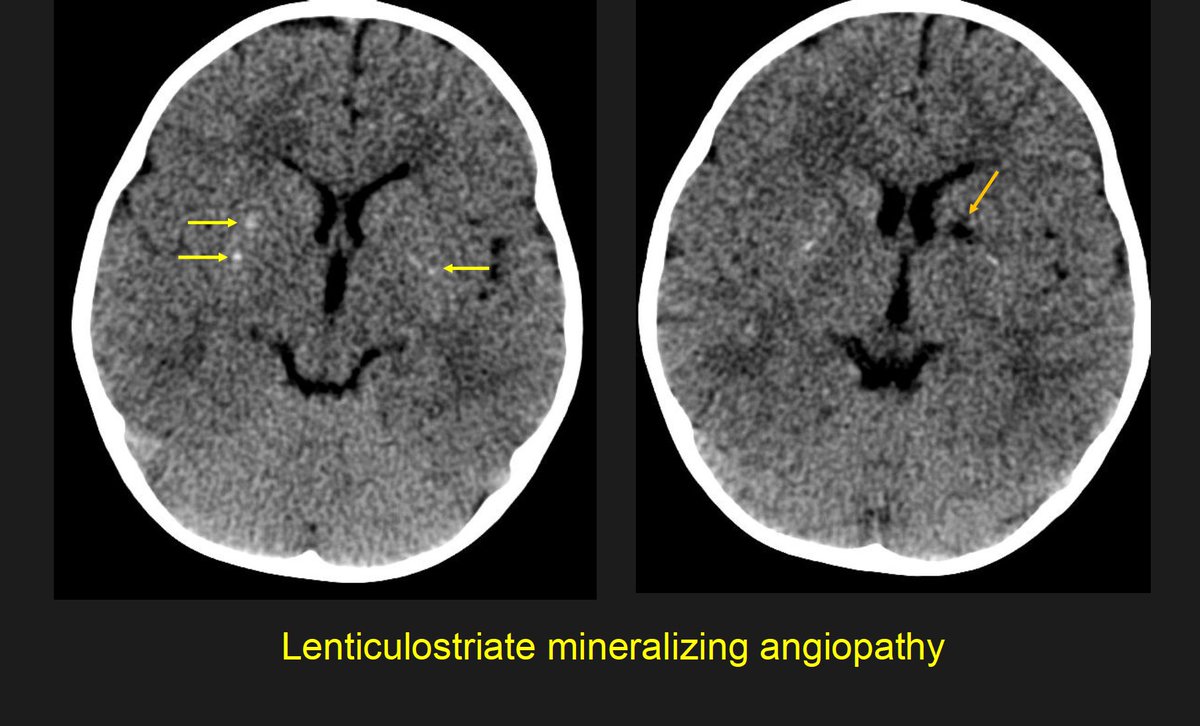 The_ASPNR's tweet photo. Live now!🧠 Dr. Gilbert Vezina concludes with high-yield  nuances✨ "The Little things matter"📖 1. Trivial trauma & basal ganglia stroke in <2 year old: Watch out for lenticulostriate mineralizing angiopathy ✨2. Don't expect coincidence: Even dermoid rupture can cause an infarct! #PediNeuroRad #PedsRad #IPNTN #ASPNR 
@MirskyDavid @drmankad @RLClarkeMD @laura1127md @ArzuOztrkMD @alexandra_foust @DrSmilySharma @HarumyYoshikawa @JamieClarkeRad @the_nvir