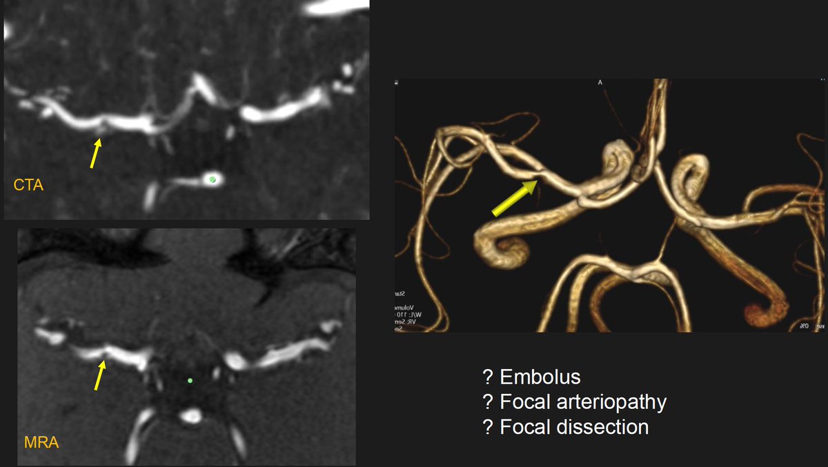 The_ASPNR's tweet photo. Live now!🧠 Dr. Gilbert Vezina concludes with high-yield  nuances✨ "The Little things matter"📖 1. Trivial trauma & basal ganglia stroke in <2 year old: Watch out for lenticulostriate mineralizing angiopathy ✨2. Don't expect coincidence: Even dermoid rupture can cause an infarct! #PediNeuroRad #PedsRad #IPNTN #ASPNR 
@MirskyDavid @drmankad @RLClarkeMD @laura1127md @ArzuOztrkMD @alexandra_foust @DrSmilySharma @HarumyYoshikawa @JamieClarkeRad @the_nvir