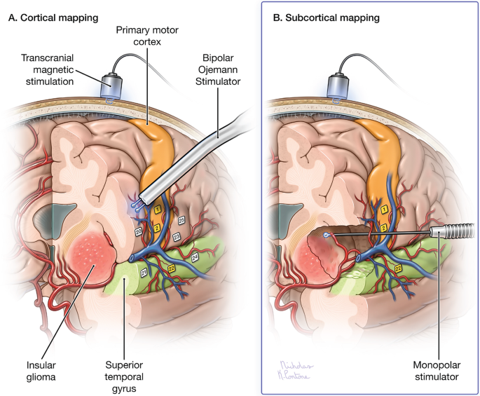 JNeurooncol's tweet photo. Advanced imaging and real-time brain mapping help neurosurgeons maximize glioma resection while preserving critical function. Chen et al outlines a protocol refined over decades to achieve maximal safe resection. Read more here: https://t.co/RIOJUR9Czu #BrainMapping https://t.co/JbriguVz3f