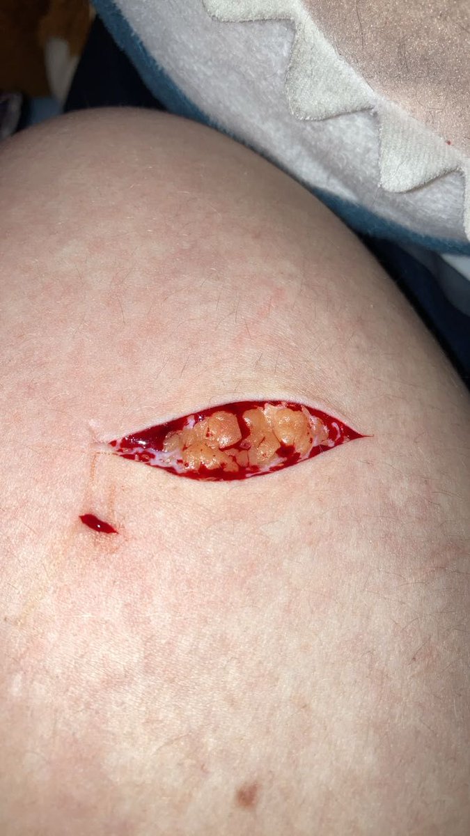 Somebodyx0714's tweet photo. This is from 3 months ago, I got stitches cus I hit a vein... Anyways.. beans beans beans.... #shtwt #beans https://t.co/qrk67dOekz