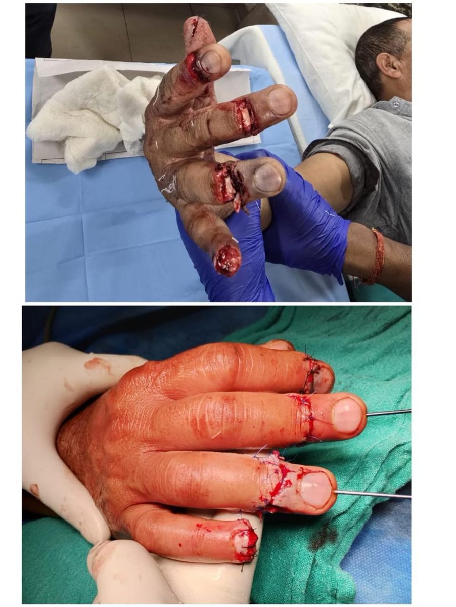 BROindia's tweet photo. #BROIndia 🇮🇳 #HealthcareHeroes #ServiceBeforeSelf
#92BaseHospital
A serving BRO Karmayogi who sustained a severe crush injury with traumatic amputation of three fingers was promptly evacuated to 92 Base Hospital, Northern Command.
Through exceptional surgical expertise and swift intervention, Team 92 BH successfully restored functional capability of the injured hand, offering renewed hope for recovery and rehabilitation.
BRO salute to the Team 92 Base Hospital for their professionalism, dedication and unwavering commitment to patient care.
🇮🇳 Service Before Self
@rajnathsingh
@SethSanjayMP
@SpokespersonMoD
@adgpi
@dgafms_mod
@NorthernComd_IA
@PIB_India
@ians_india
@ANI