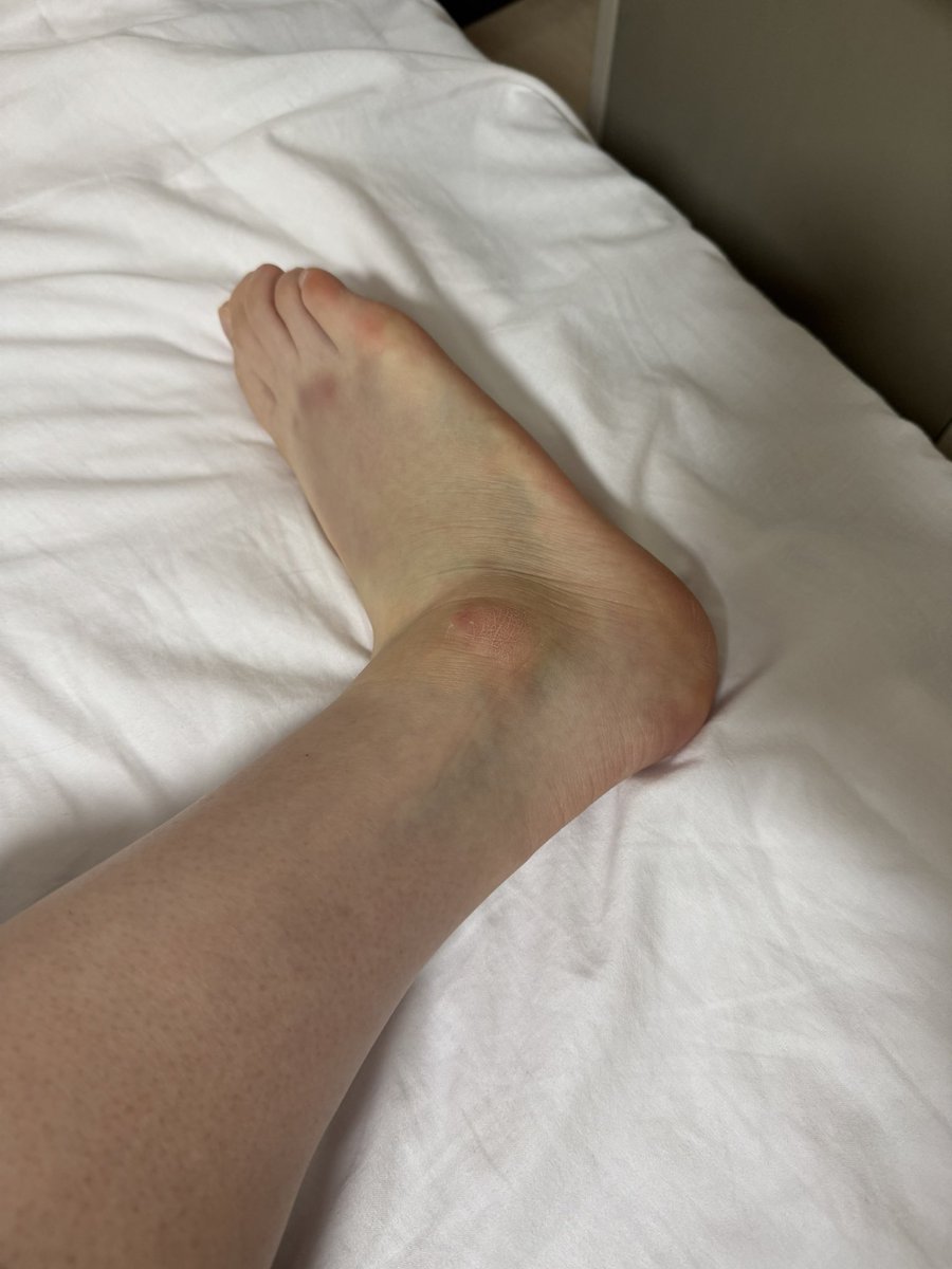 15080aoi's tweet photo. 足の甲も外くるぶしも内くるぶしもまだ内出血、腫れはありますけど歩けるまで回復しました。７月13日からの広島から走れるように専念します！！ https://t.co/fwZ0b8N07Q
