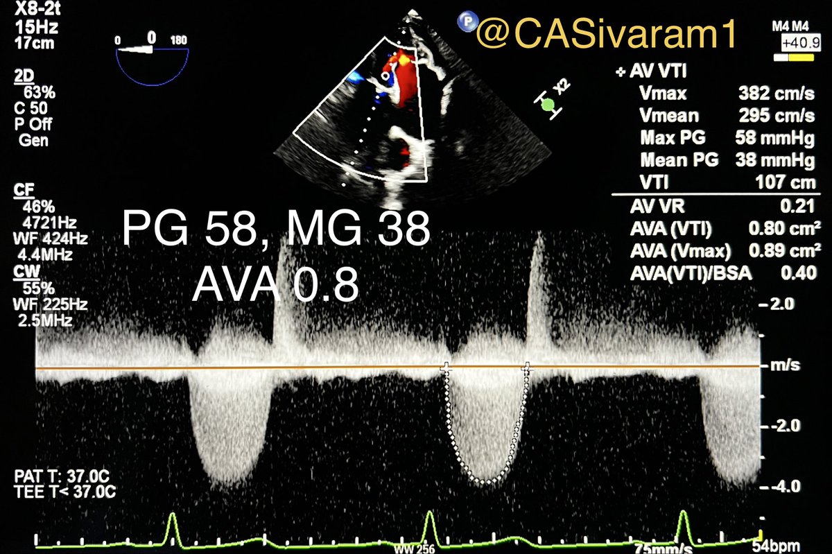 CASivaram1's tweet photo. #echofirst
✅ Interesting recent discussion on relationship of AT to flow through large vs small orifice
✅ Example ⬇️ of unusual difference in ATs of LVOT PWD obtained at 2 sites by TEE during TAVI
✅ Two deep transgastric views (at 0 & 140 degrees) 
✅ Visually & by measurement differences in  AT of LVOT PWDs seen
✅ Longer AT when PW sampled below calcified AV cusp (see composite image). LVOT velocities 91 vs 72 cms at 2 sites
✅ Comments? 
@argulian 
@EchoSoliman 
@echo_batman 
@EchoProsto 
@iamritu 
@Hragy