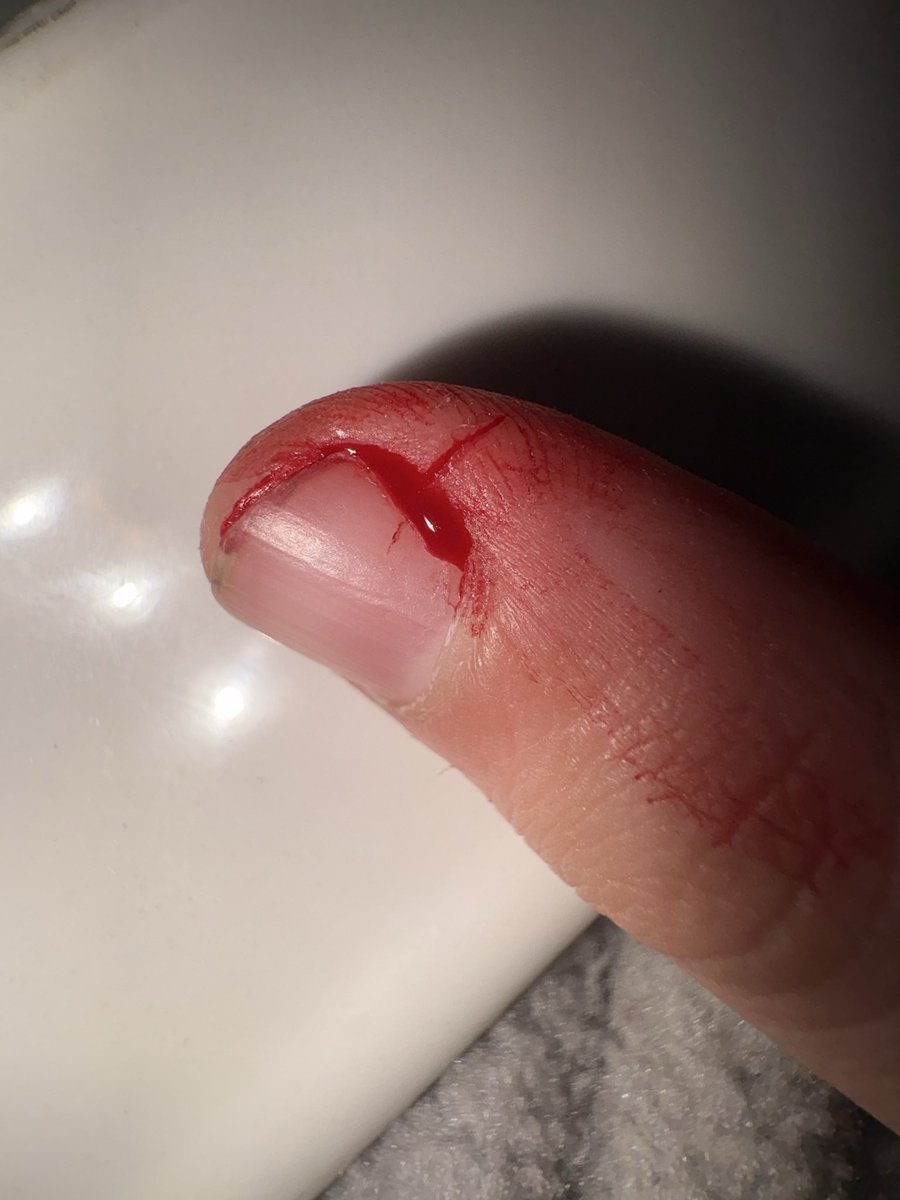 curtainscalling's tweet photo. hit styro on my thumb IM CTFU😭 the one time im not actively tryna cut is the time when i get injured https://t.co/Ez9sKEx9Ou