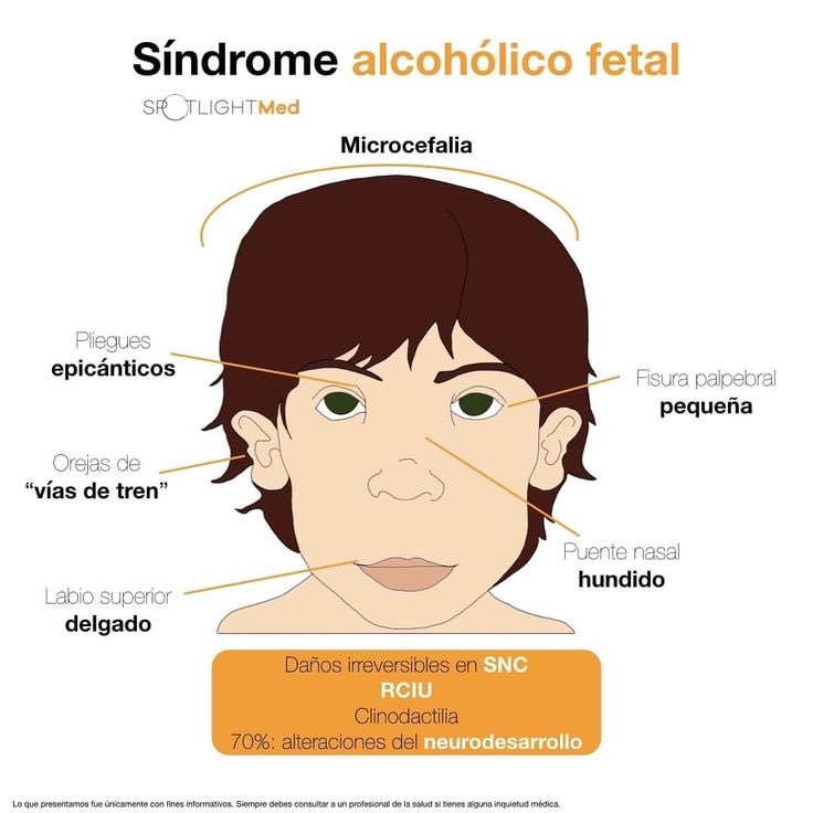 scharlettemtz's tweet photo. Ahora qué ladran mis síndromes alcohólicos fetales? 

Aquí unas fotitos de ellos 🤗

Encuentren sus diferencias 🤣

Están igualitoooos! 

Lógico, los gestaron padres alcohólicos! https://t.co/KeC2mPFjS1