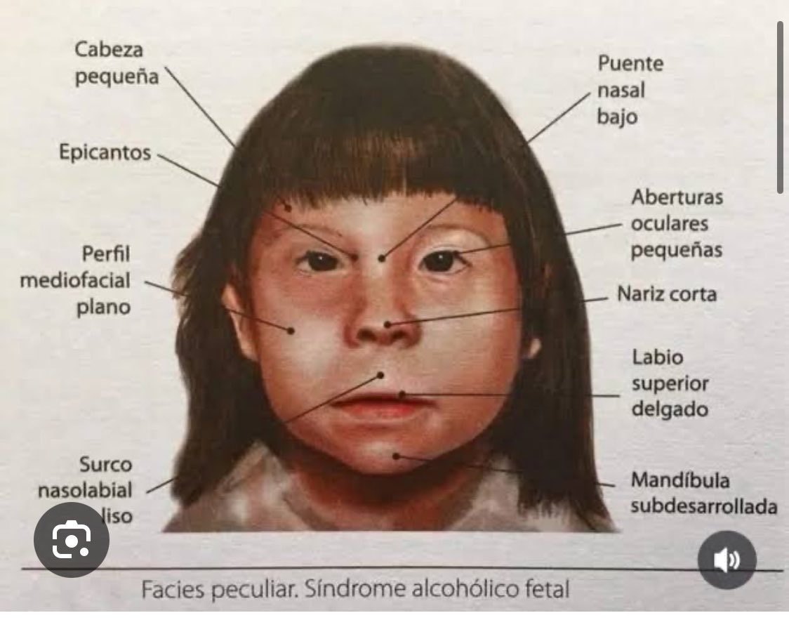 scharlettemtz's tweet photo. Ahora qué ladran mis síndromes alcohólicos fetales? 

Aquí unas fotitos de ellos 🤗

Encuentren sus diferencias 🤣

Están igualitoooos! 

Lógico, los gestaron padres alcohólicos! https://t.co/KeC2mPFjS1