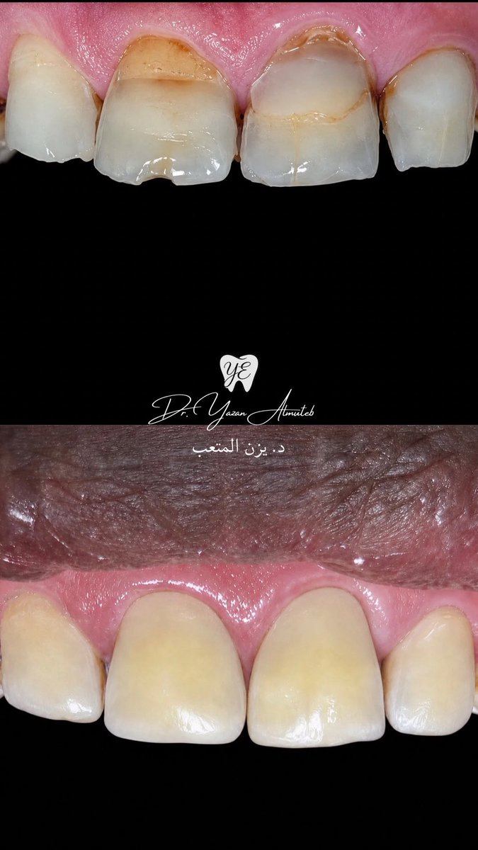 yazanEDT's tweet photo. From compromised anterior teeth to a functional and esthetic smile

Direct composite restorations performed with a minimally invasive philosophy and maximum respect for the remaining tooth structure👏🏼