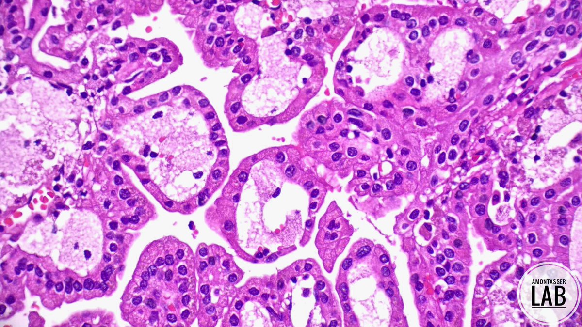 AMontasserMD's tweet photo. 🔬 Papillary RCC 

#GUpath #PathX #PathTwitter #Pathology