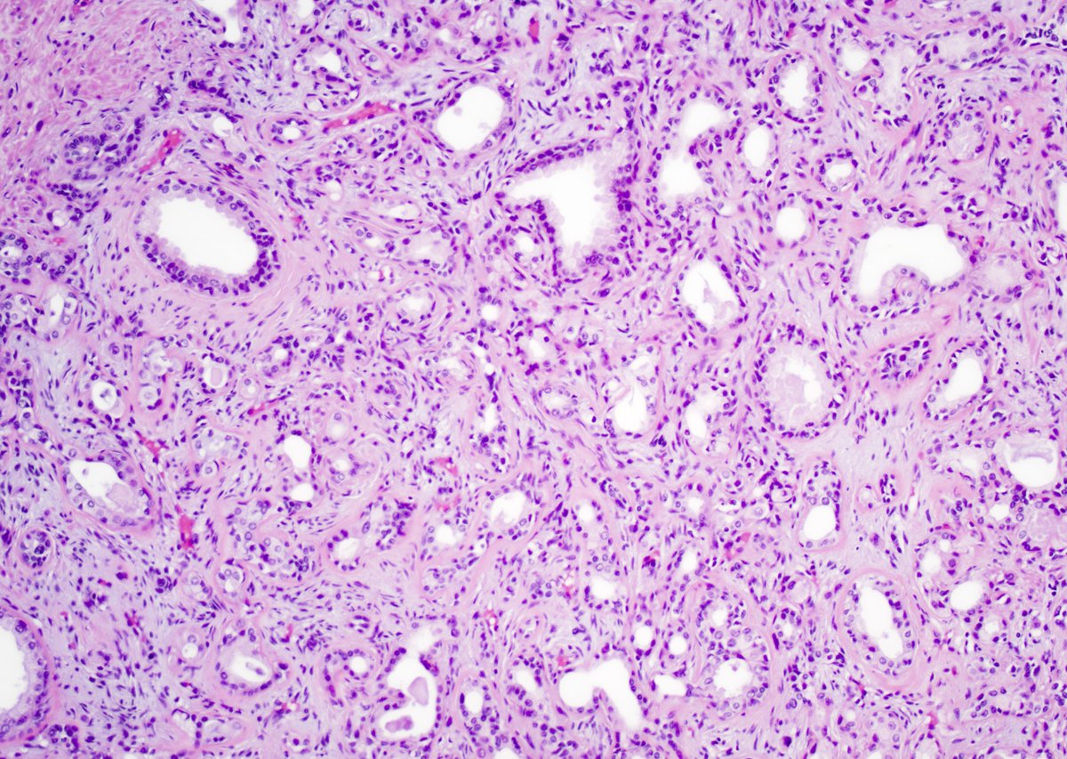 GuannanTiffany's tweet photo. 🧩 Prostate riddle

TURP chips. 🤔

This lesion has a well-known twin sister in the breast.

What is your diagnosis?

#DxMindMap #ProstatePath #GUPath #PathTwitter @JHUpath https://t.co/UlEajYpaKf