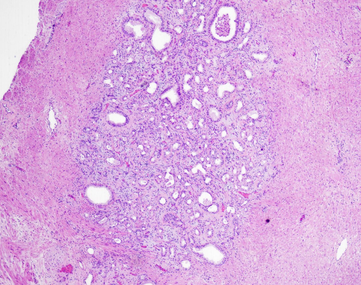 GuannanTiffany's tweet photo. 🧩 Prostate riddle

TURP chips. 🤔

This lesion has a well-known twin sister in the breast.

What is your diagnosis?

#DxMindMap #ProstatePath #GUPath #PathTwitter @JHUpath https://t.co/UlEajYpaKf