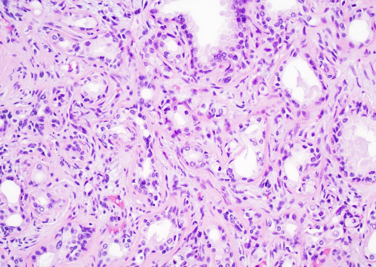GuannanTiffany's tweet photo. 🧩 Prostate riddle

TURP chips. 🤔

This lesion has a well-known twin sister in the breast.

What is your diagnosis?

#DxMindMap #ProstatePath #GUPath #PathTwitter @JHUpath https://t.co/UlEajYpaKf