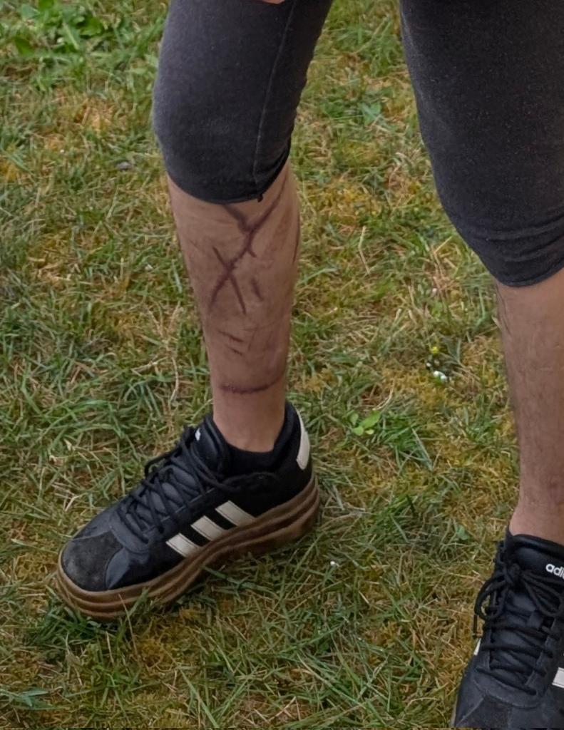muUted_'s tweet photo. My scars are so visible and embarrassing, what excuses am I meant to find?? I look like I've been thrown in a lion cage or tortured idk. I don't like summer :( https://t.co/9HY45FayxM