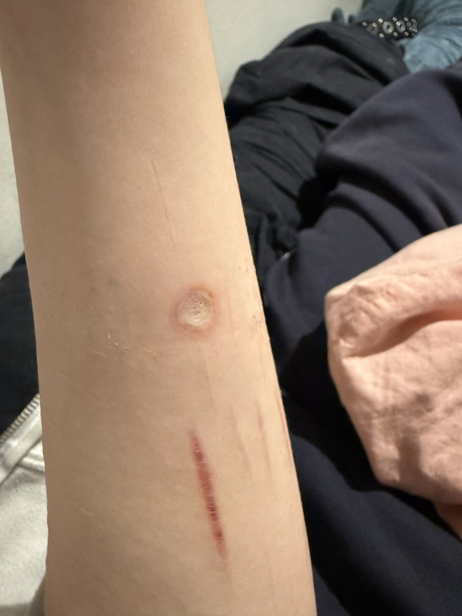 izzkyou's tweet photo. #sh #shtwt 

Burn from uh Thursday I think yes 

It’s numb, it’s a sign it’s gonna hurt so bad 💔 hopes and prayers https://t.co/AZEN4zP38f