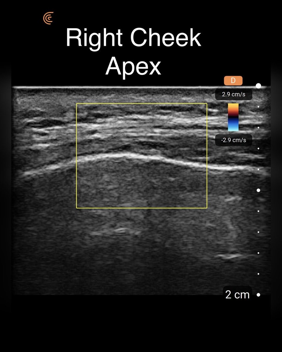 VysanaLife's tweet photo. I use ultrasound before I treat.
Last week it showed subclinical swelling in a patient's cheek that wasn't visible on surface assessment.
Treatment postponed. Good outcome avoided becoming a bad one.
This is why imaging matters in aesthetic medicine. https://t.co/jNvafUf561