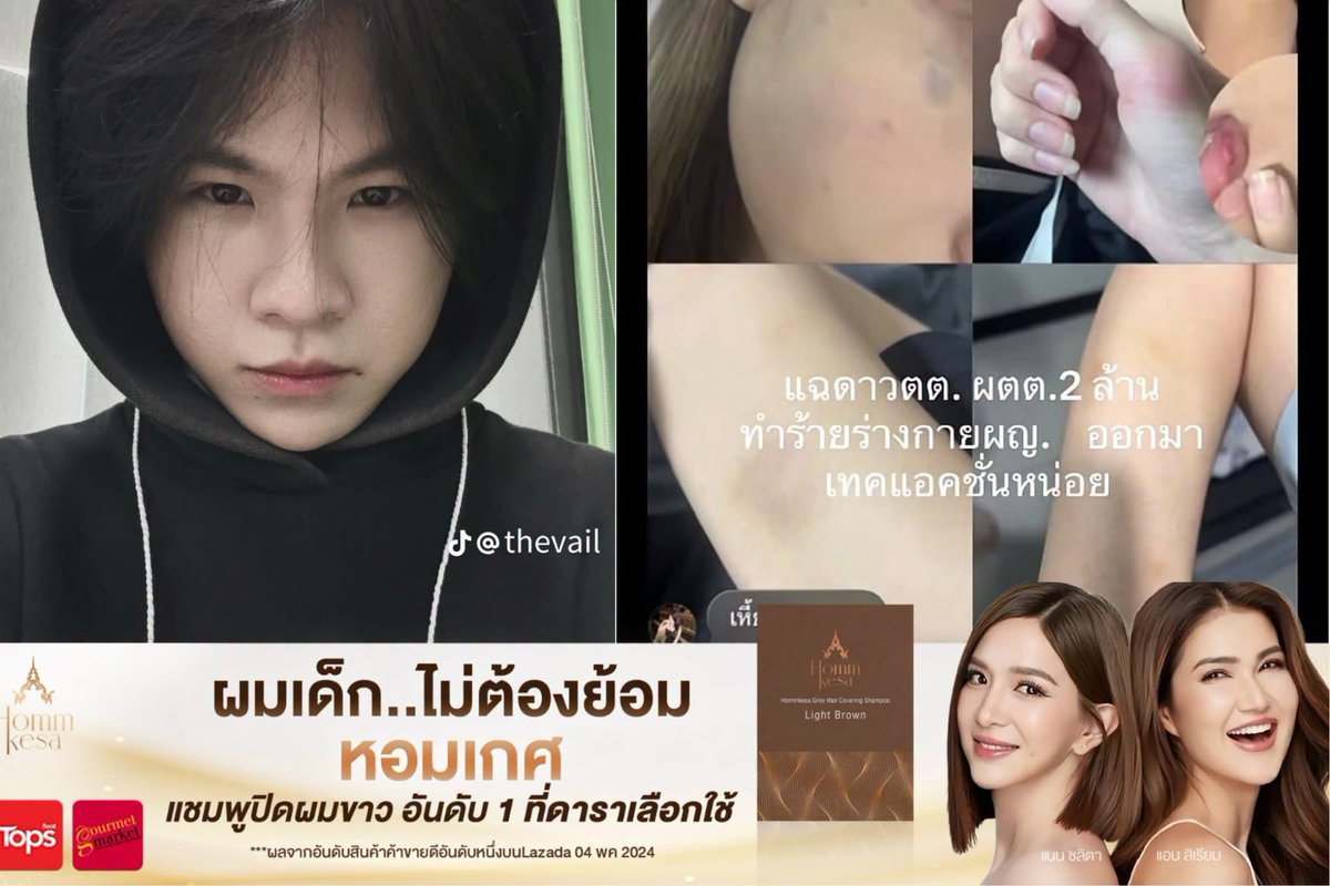 shopevtyw's tweet photo. 📣 เพจอรรถรส 🚨 สรุปดราม่าร้อน #ดาวTikTok 2 ล้าน โดนแฉทำร้ายร่างกาย ฝ่ายชายไม่ยอม ‼️ งัดกล้องวงจรปิดสวนกลับ กลายเป็นมหากาพย์รักเดือด
👦🏻 ฝ่ายชายสวนกลับทันที ปล่อยวงจรปิดอีกมุมแฉกลับ ฝ่ายหญิงแย่งมือถือแล้ววิ่งหนี ตอกเจ็บ #ชอบเล่นบทเป็นเหยื่อหรอ
👩🏻ฝ่ายหญิงยอมรับ "พังทั้งคู่" ที่ผ่านมาอารมณ์ร้อนตบตีกันทั้งสองฝ่ายจริง แต่พักหลังฝ่ายชายเริ่มรุนแรงขั้น บีบคอ ต่อย เตะ จนทนไม่ไหว ย้ำการทำร้ายร่างกายไม่ควรเป็นเรื่องปกติ
🗣️ชาวเน็ตสับยับ พฤติกรรมเข้าข่าย Toxic Relationship รุนแรงใส่กันไปมา ชี้ไม่ว่ายังไงก็ไม่ควรมีใครถูกทำร้ายร่างกาย! 💥 
Cr. เพจอรรถรส