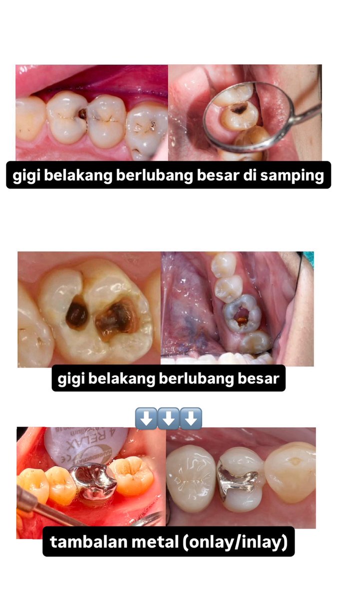 dentaldentsambu's tweet photo. @tanyarlfes Halo temen2, aku koas kedokteran gigi di Jakarta Pusat lagi cari pasien gigi berlubang besar seperti digambar dan ingin dirawat. Gigi yg telah dirawat akan dilakukan tambalan metal seperti pada gambar. yang berminat boleh DM aku, free of charge juga yah #koasgigi #butuhPSA https://t.co/qGnntfRjRM
