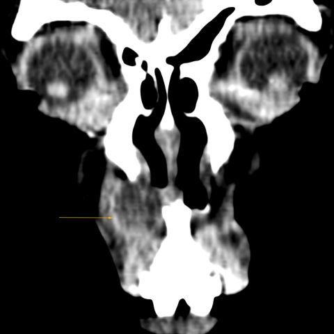 myESR's tweet photo. This week's featured #EuroRad case highlights a 50-year-old female, with a painless swelling in the right nasal alar region, gradually increasing over 1 year. No nasal obstruction, discharge or trauma history was reported. 
 
What do you think the diagnosis could be?

Read more about this case here: https://t.co/0RF9O7AkHs