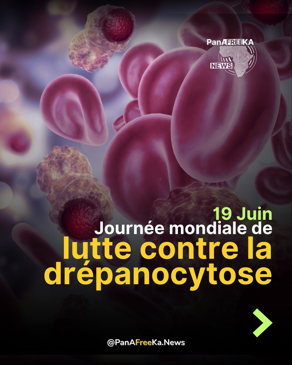 PanAFreekaNews's tweet photo. La drépanocytose est la maladie génétique la plus répandue au monde, touchant principalement les populations africaines et afrodescendantes. Malgré son impact considérable sur des millions de personnes, elle demeure largement sous-financée et moins étudiée que d'autres maladies affectant davantage les pays les plus riches. De nombreux chercheurs et acteurs de santé publique soulignent que cette inégalité reflète également des déséquilibres historiques dans les priorités de la recherche médicale mondiale.

D'un point de vue scientifique, la drépanocytose est particulièrement fréquente dans les régions où le paludisme était ou demeure endémique. Le port d'un seul gène de la maladie confère une protection partielle contre les formes graves du paludisme, ce qui explique pourquoi cette mutation s'est maintenue au cours de l'évolution dans certaines populations.

Face à cette réalité, il est essentiel de renforcer la prévention et la solidarité. Le dépistage avant d'avoir des enfants permet aux futurs parents de connaître leur statut génétique et de prendre des décisions éclairées. Le don de sang est également vital, car de nombreux patients drépanocytaires dépendent de transfusions régulières pour survivre et améliorer leur qualité de vie.

Adopter une approche décoloniale de la santé, c'est aussi reconnaître que toutes les vies méritent le même investissement scientifique, indépendamment de leur origine géographique ou ethnique. Accroître les financements, soutenir la recherche et améliorer l'accès aux soins pour les personnes atteintes de drépanocytose constituent des impératifs de justice sanitaire.