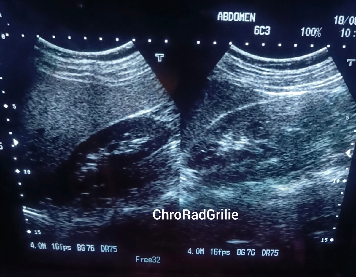 ChroRadGirlie's tweet photo. Why is the right kidney looking dark 🌑 https://t.co/RMEjRneSnn