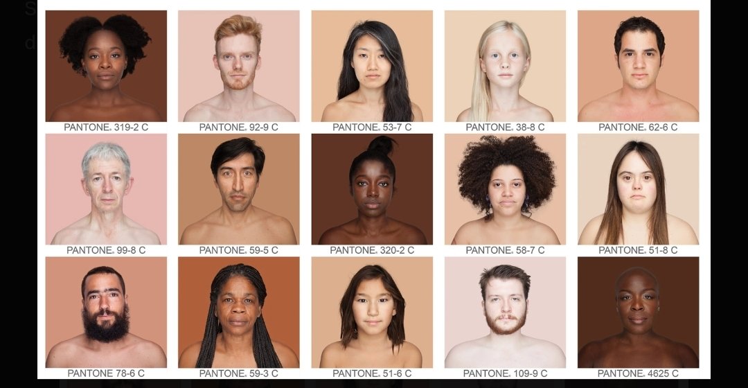 vickAlmondo's tweet photo. Cut the performative bullshit. East Asian skin, Koreans, Japanese, Chinese, is built different, and the endless online meltdowns about “natural” skin tone prove most people have no clue how biology actually works.

East Asians typically land on Fitzpatrick skin types III to IV. Type III: sometimes burns, tans to light brown. Type IV: burns minimally, tans to a solid moderate brown. This isn’t theory. It’s dermatology. Their skin produces melanin efficiently when hit with UV. It doesn’t turn into a peeling lobster like a ginger from Ireland (Type I-II). It darkens to protect itself.

That’s exactly why Korean football/soccer players look noticeably darker after training under the sun all day. Their skin is doing what it’s genetically wired to do. Baseline pale skin? That’s what you get when someone lives indoors, wears SPF like armor, and follows the cultural script. 

It’s not some immutable racial default, it’s the result of low sun exposure.

The Korean (and broader East Asian) pale skin thingThis isn’t some secret plot to “become white.” It’s ancient colorism tied to class. Pale skin meant you weren’t a peasant sweating in the rice fields. It signaled refinement, indoor life, higher status. Confucian hierarchy baked that in centuries ago. Today it’s a multi-billion-dollar brightening industry because the preference stuck culturally. 

Same dynamic exists across Asia; India, China, Japan, Southeast Asia. Internal. Pre-colonial in many cases. Westerners love to flatten it into “they want to look like us” because it fits a simple oppressor/oppressed script. It doesn’t.

Americans and the skin-tone = race trap

Here’s where it gets especially stupid on this side of the Pacific. Americans are obsessed with skin color as the primary racial marker. 

Light = white/privileged. Darker = POC/victim.

 Everything else is noise. So when East Asians tan up, or show natural medium tones, or have skin that responds to the sun like normal human skin, the categories break and the cope begins.

“They’re not really tan, it’s just temporary.”

“Their natural state is pale, so they’re white-adjacent.”

“Colorism in Asia is because of Western influence.”

All lazy. Skin tone is one polygenic trait that’s highly responsive to environment. Populations have averages shaped by evolution (UV protection vs. vitamin D synthesis), but within every group there’s massive variation. 

A pale indoor Korean and a tanned outdoor one are the same ancestry. A fair Italian and a pasty Swede are both “white” on paper but respond differently to sun. 

Biology laughs at your checkboxes.