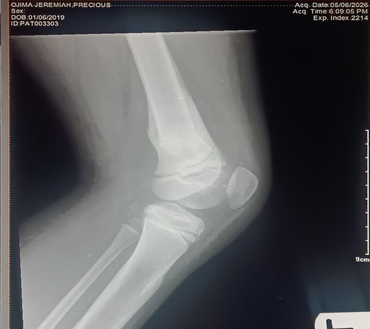 efukunjerry's tweet photo. @Wizarab10 Just need a support for my 7 year knee surgery.  She was play football with her younger brother and fell. We have been going different places. The Xray https://t.co/Yk6DCFiN7a