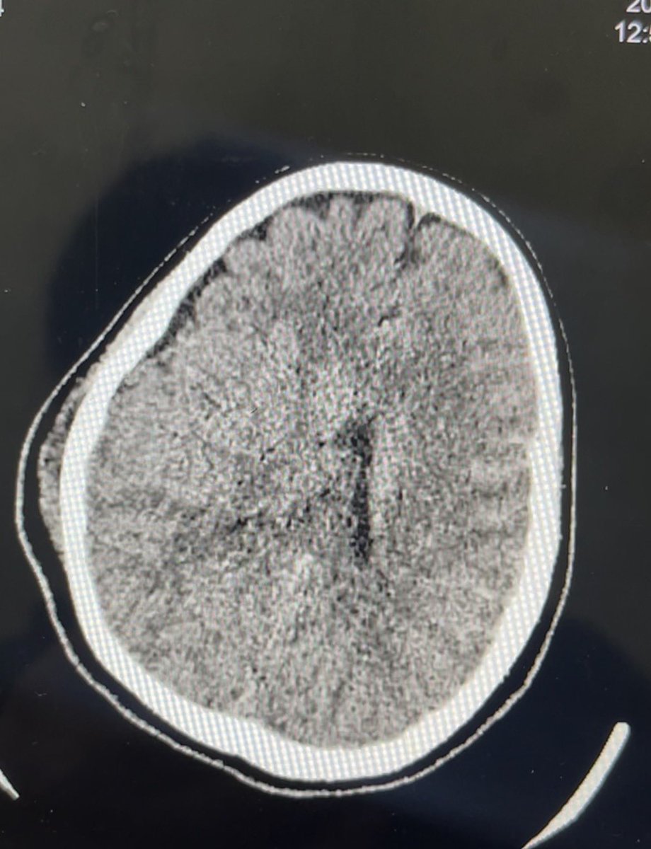 fistaloka's tweet photo. Lain kali hati hati yaa dijalan, pakai helm. We never know what happened next, pasien Ny.X 23 thn, ditemukan tidak sadarkan diri

hematoma (+) (tidak raccoon eye, battle sign (-)) perdarahn keluar dari hidung (+) dari hasil CT scan ditemukan Epidural Hematoma temporal sisi kanan😔

Please yg naik motor ya, tolong pake helm, bener bener klo ngantuk jangan berkendara 😔😔😔