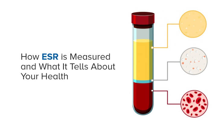 sctBarisere's tweet photo. Who should do an ESR test: 💡 
Individuals experiencing unexplained symptoms (like persistent fevers, joint pain, or significant weight loss) or to monitor diagnosed autoimmune and chronic inflammatory diseases. https://t.co/jDj2uN8PGK