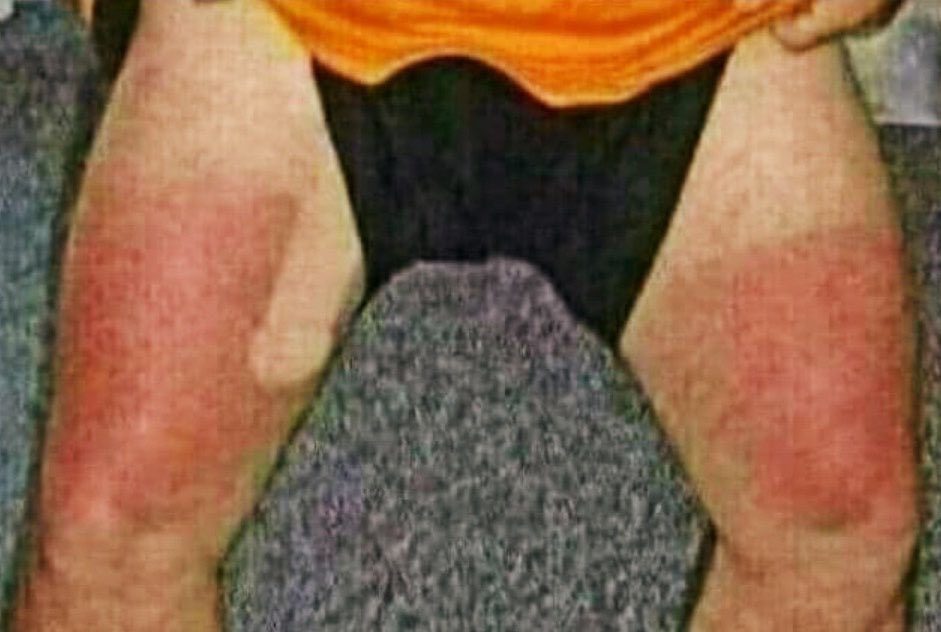 StansaidAirport's tweet photo. Damn. Caught a little too much sun today. https://t.co/6RdEo6hUBd