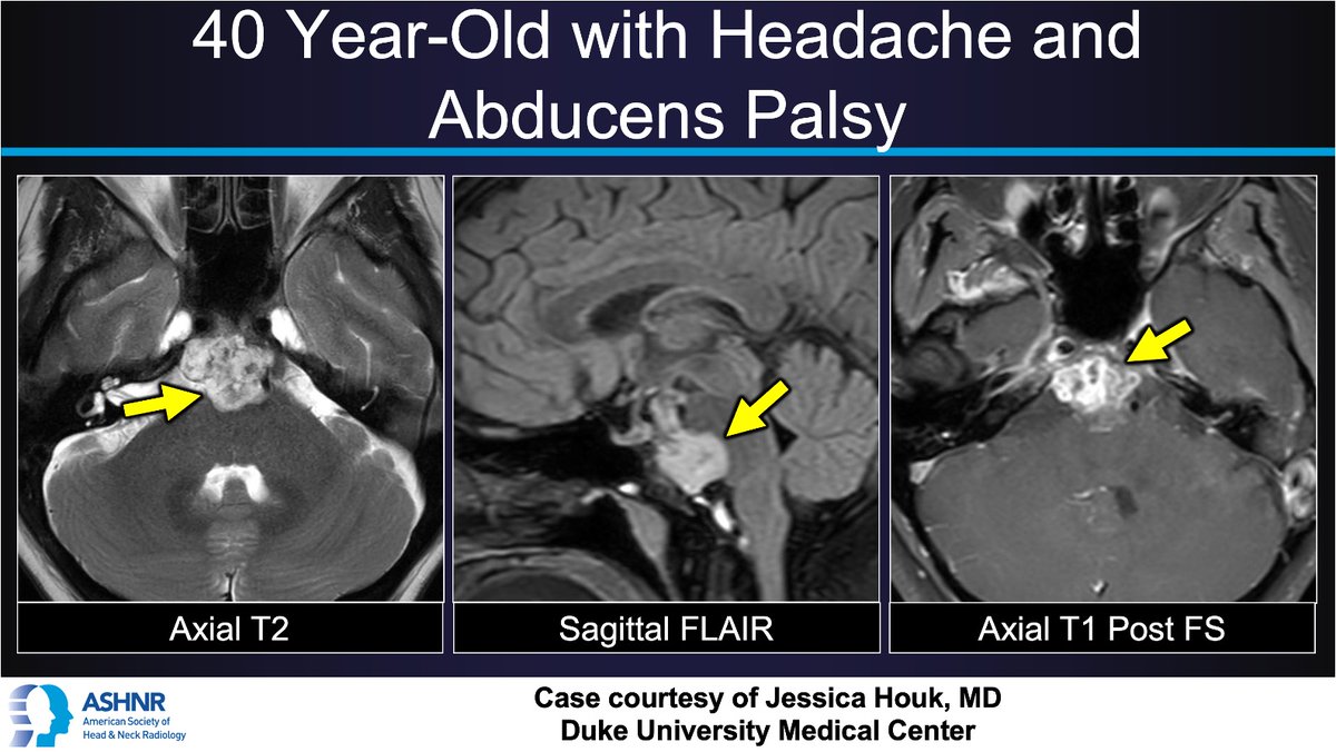 ASHNRSociety's tweet photo. #ASHNRCOTW 345: ANSWER.  Thx
@jhoukMD 4 case! #ASHNR26                       

@callyrobs @DShatzkes @CDP_Rad @rhwiggins @nakoontz @KRileyMD @CMGlastonbury @tabby_kennedy @PhilipRChapman1 @cmtomblinson @amyfjuliano @bpoliceni @MohitTCCNeuro @AshokSrini15 @KatieTraylorDO @CynXinWu https://t.co/wUz8leuGS9