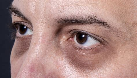 questmoosa's tweet photo. Dark circles under the eyes is NOT due to genetics

Dark and purple circles under the eyes is due to 3-7 things:

- Lymphatic stagnation
- Tight/Weak neck & jaw muscles compressing the lymphatic vessels and jugular veins
- Low thyroid hormone T3
-Poor facial structure due to poor tongue posture
- Elevated PTH and prolactin (due to decreased calcium consumption)
- Loss of CO2 causing vasoconstriction 
- Poor posture

Focusing on improving one factor will help to improve all the other factors and help start a positive forward feedback loop.

Get started!