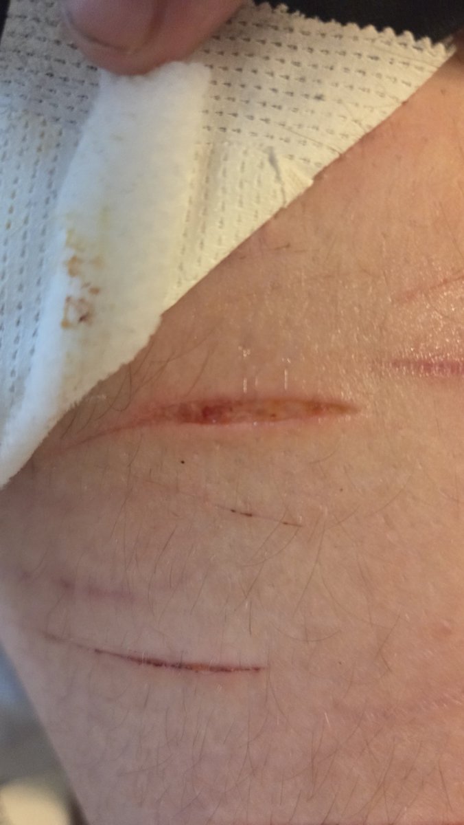 Child_o_stars's tweet photo. Is this infected? I think it is, but I cant tell.
Tw: open wound
#sledtwt #bbbeans #styrotwt #ouchietwt #slittwt https://t.co/zFywOjV9yk