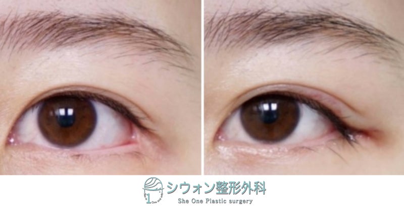 SheOnePS's tweet photo. シウォン整形外科です🧐
「目尻切開修正が失敗する原因とは？」👁️
修正手術をご検討中の方はぜひブログをご覧ください！

💻 BLOG：https://t.co/swNiEzVZfu

📲 LINE : https://t.co/z0EmVPZdrK
⏺️ Instagram : https://t.co/z6rbwXiFvk

#韓国整形 #シウォン整形外科 #韓国美容整形 #渡韓整形 #目整形 #眼整形 #修正手術 #美容外科 #整形外科 #美容整形 #美容整形外科 #韓国整形外科 #韓国美容外科 #目尻切開 #タレ目形成 #副作用 #整形副作用 #目尻切開修正 #目尻修正 #結膜露出