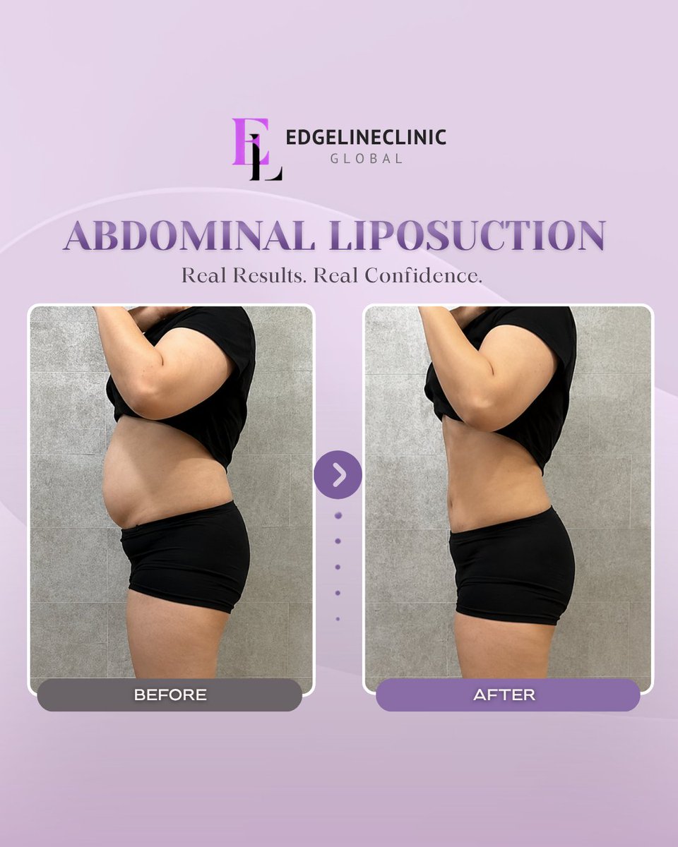 edgeline_global's tweet photo. See how abdominal contouring can help refine the waistline and enhance overall body proportions.

📩Book today!
WhatsApp: +82 10 3970 2135
Email: edgelinegangnam@naver.com
WeChat: edgeline_gangnam
LINE: @343tnxkn

#abdominalliposuction #korealiposuction #koreaplasticsurgery https://t.co/whBGXaX6FF