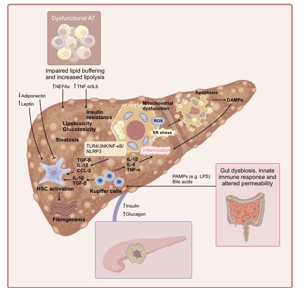 cristinatejerap's tweet photo. 🔬 Nueva revisión en @DiabetologiaJnl ➡️los motores metabólicos de MASLD y MASH ➡️ del desequilibrio hormonal a la fibrosis.

🔹 La disfunción del tejido adiposo y el desequilibrio insulina–glucagón son el eje central

🔹 La fibrosis (no la inflamación) predice el pronóstico… y puede regresar si mejora la disfunción metabólica

🔹 Dianas terapéuticas con base mecanística: resmetirom (THR-β), AR GLP-1, lanifibranor (pan-PPAR), análogos FGF21/19

Medicina de precisión para frenar la progresión hepática 👇

🔗 https://t.co/K1crEXGIF6