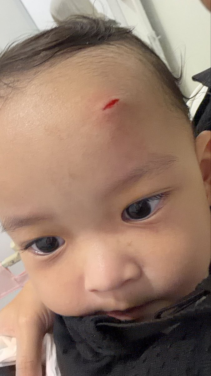 wndurbyyn's tweet photo. Dulu kegiatan pup pip nangis tidur sekarang astaghfirullaaaaah
Kiri kejatuhan tutuo panci jarak 2 minggu yg kanan jatuh dan dijahitttttrrr😭😭😭😭😭😭 https://t.co/c4GYfPK1WD
