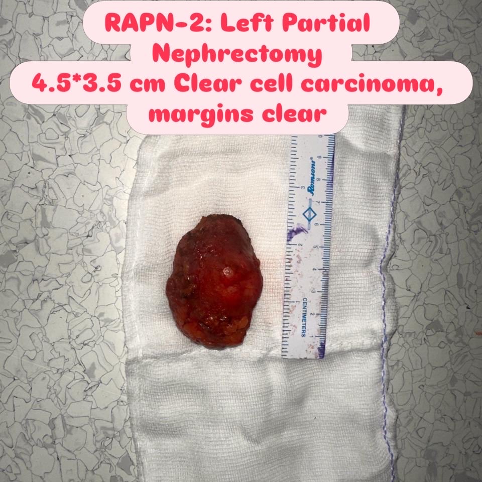 DrDeepakJK's tweet photo. 4 Robotic Partial Nephrectomies ☺️😎 
(for Kidney Cancer) in 10 days in 
April-May month😎

All Histopathology- Margins clears!👍

2 months post surgery all 4 patients:
Doing well👌Without any peri operative complications!😊

Challenging cases, kidney saved &amp; cancer removed!😎🙏 https://t.co/mkP8llA5DU