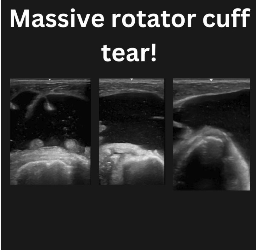 MillwardLuke's tweet photo. When your shoulder scan starts with a huge amount of anechoic fluid within the sub acromial space it can only mean one thing. A massive rotator cuff tear resulting in an effusion emanating from the glenohumeral joint collecting on the bursal plane! https://t.co/eFtmiWPU1y